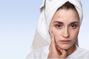 7 Sfaturi pentru pielea acneică