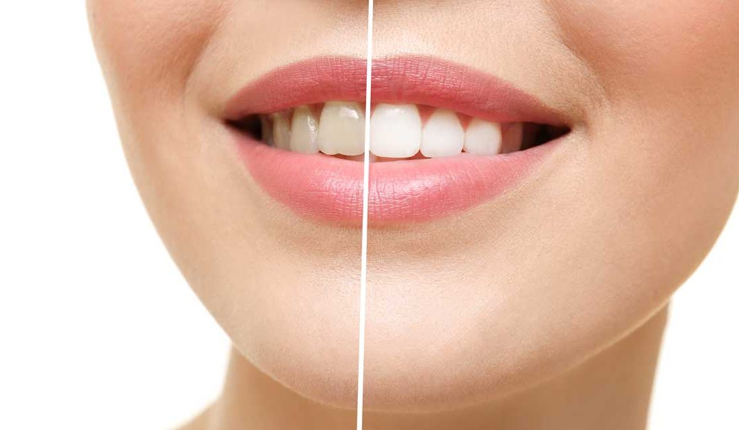 Image result for whitening